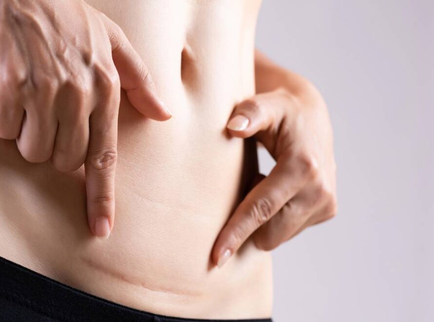 Mulher apontando para cicatriz de cirurgia