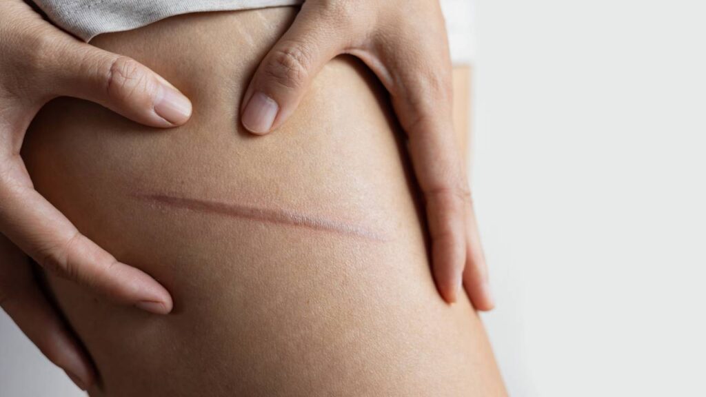 Mulher com cicatriz na perna