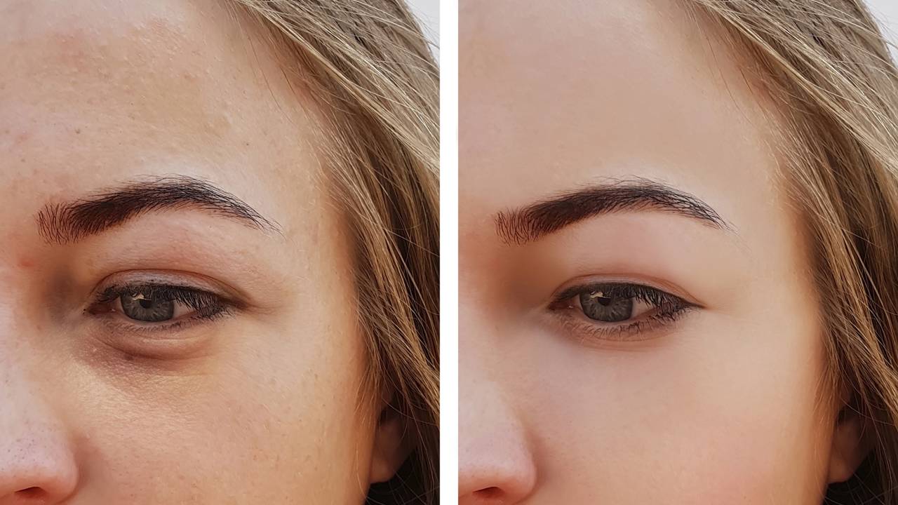 Comparação de inchaço do rosto de mulher