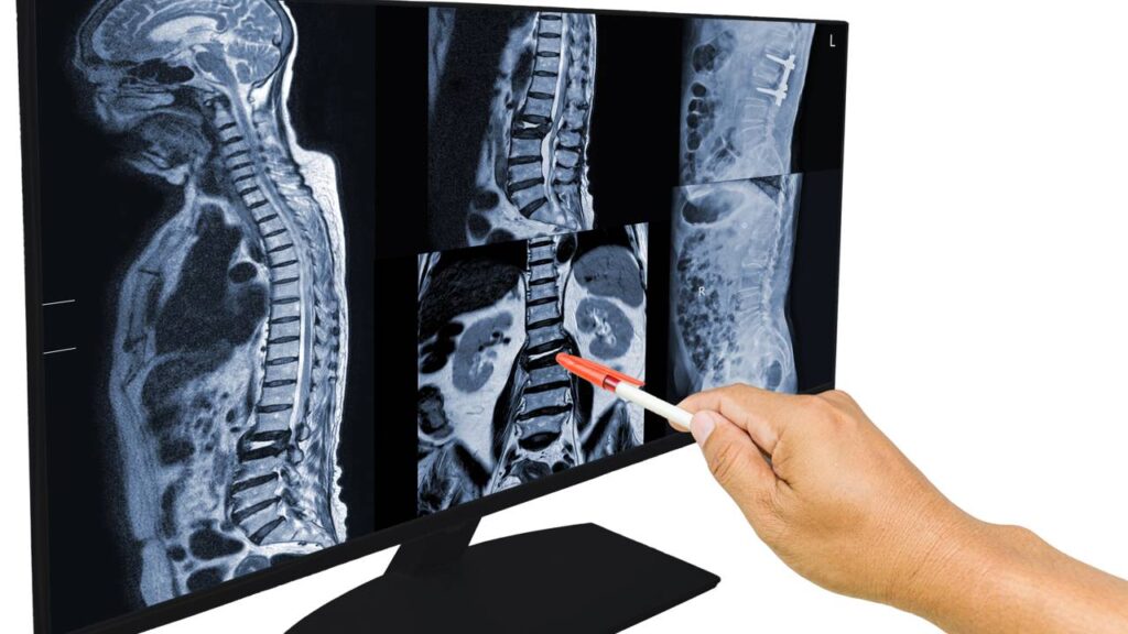 Médico apontando para monitor com raio-x de um diagnóstico de compressão lombar