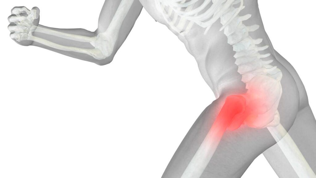 Representação 3D de quadril travado