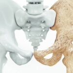 Representação 3d de ossos do quadril com osteoporose