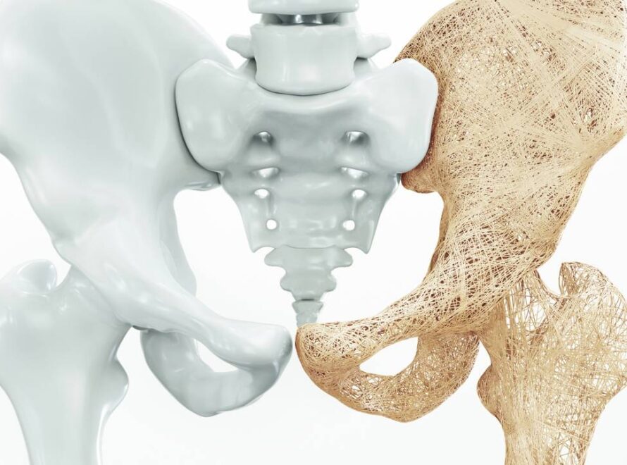 Representação 3d de ossos do quadril com osteoporose